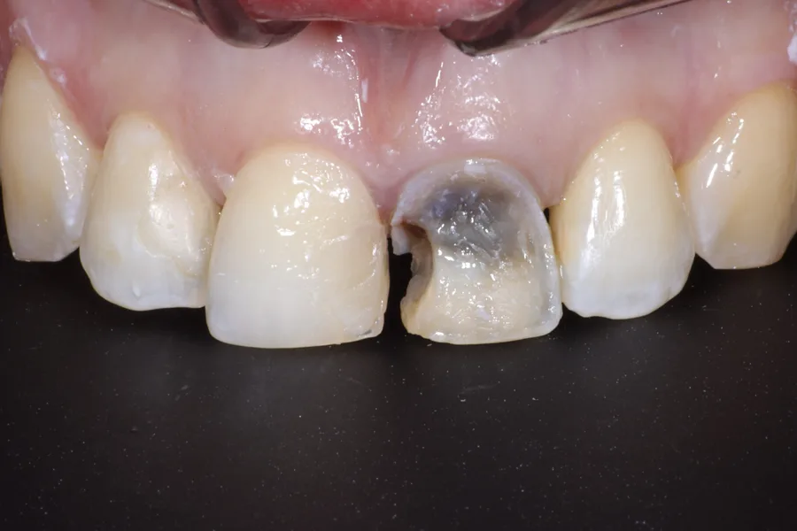 Antes — diente oscuro por endodoncia y restauración defectuosa, ProClinic UIO